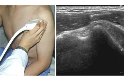 어깨 초음파검사 장면 및 초음파 영상